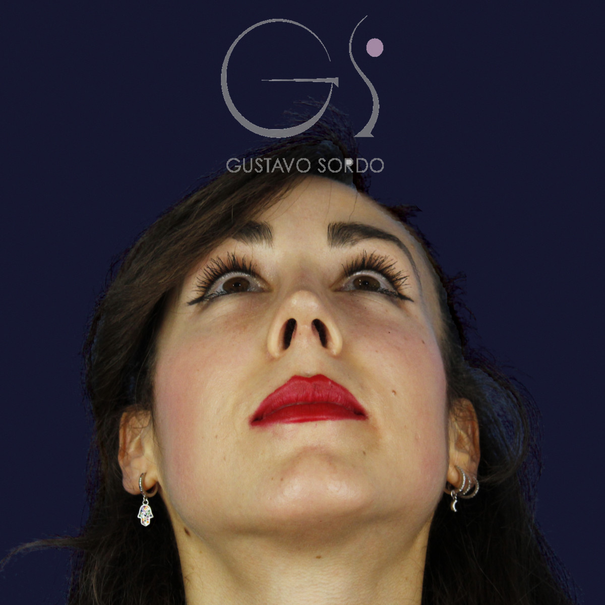 Rinoplastia estructural en piel fina con giba en S, mentón arriba, al año de la operación — caso del Dr. Gustavo Sordo en Madrid