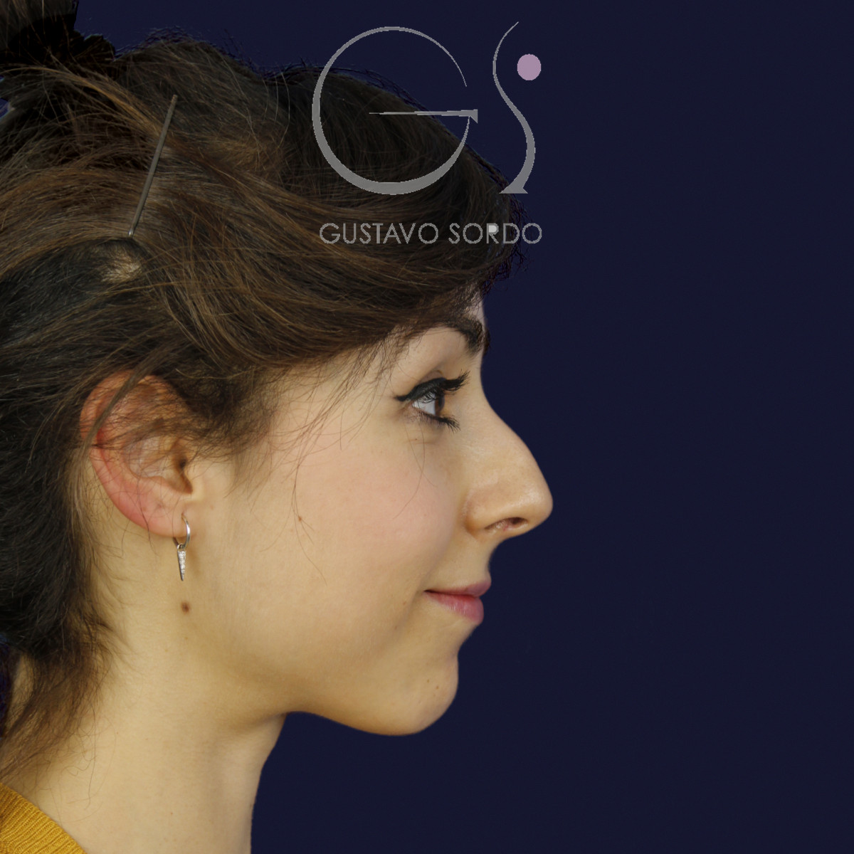 Rinoplastia estructural en piel fina con giba en S, perfil derecho sonriendo, antes de la cirugía — caso del Dr. Gustavo Sordo en Madrid