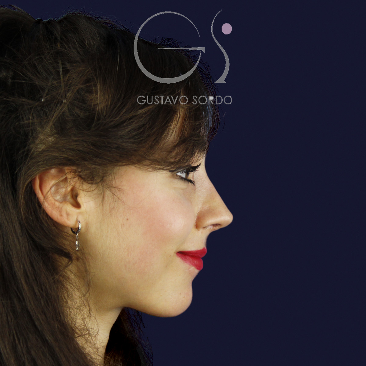 Rinoplastia estructural en piel fina con giba en S, perfil derecho sonriendo, al año de la operación — caso del Dr. Gustavo Sordo en Madrid