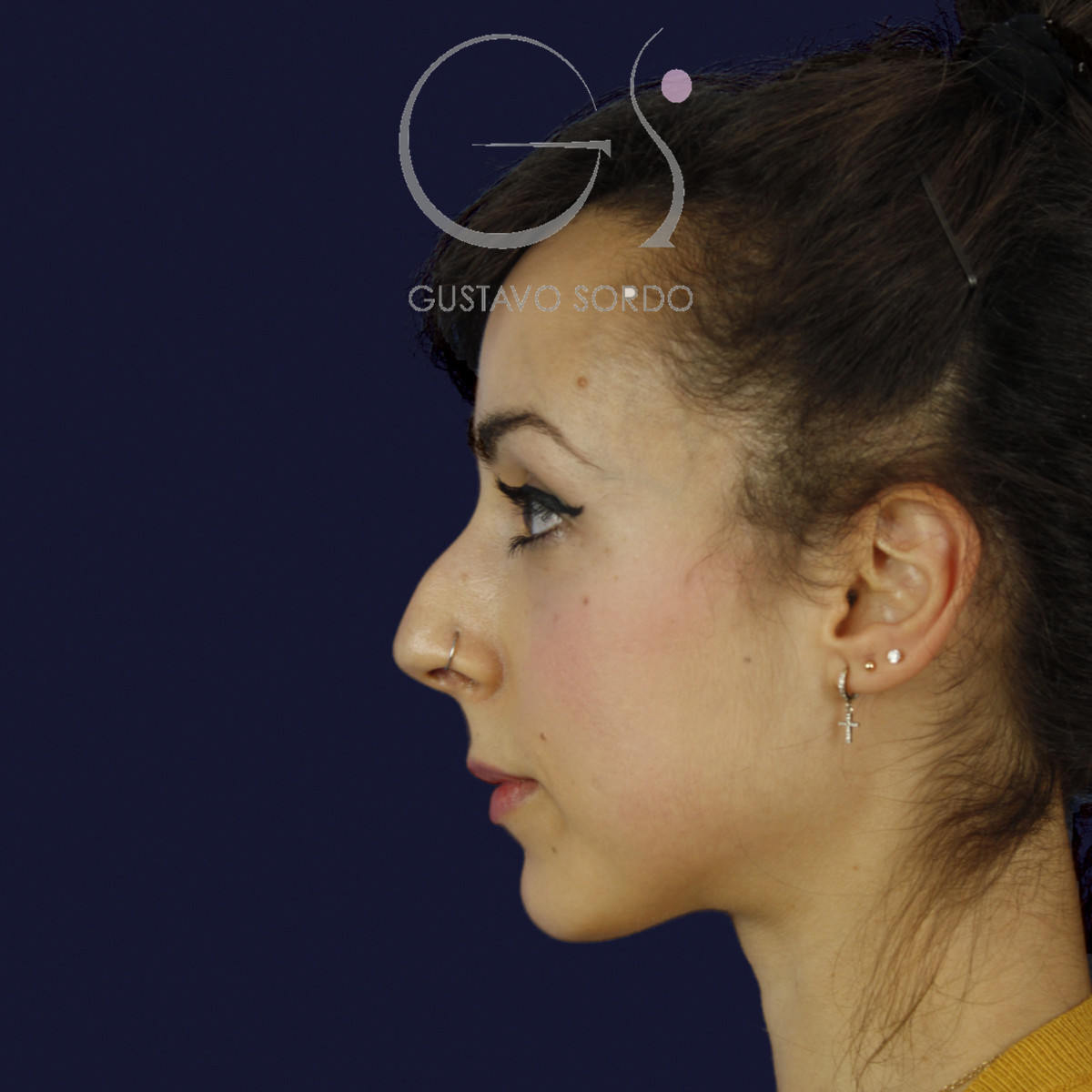 Rinoplastia estructural en piel fina con giba en S, perfil izquierdo, antes de la cirugía — caso del Dr. Gustavo Sordo en Madrid