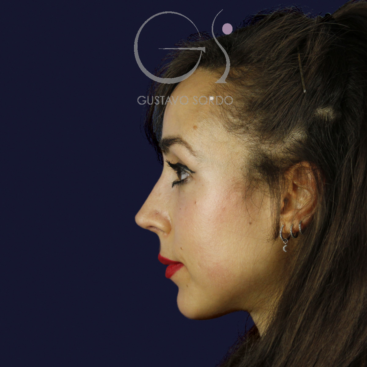 Rinoplastia estructural en piel fina con giba en S, perfil izquierdo, al año de la operación — caso del Dr. Gustavo Sordo en Madrid