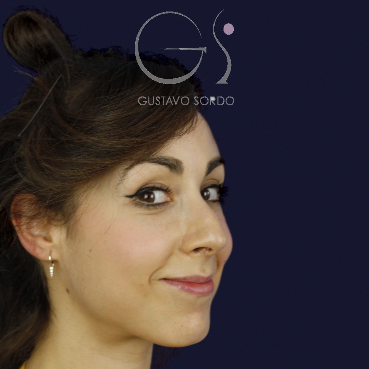 Rinoplastia estructural en piel fina con giba en S, semiperfil derecho, antes de la cirugía — caso del Dr. Gustavo Sordo en Madrid