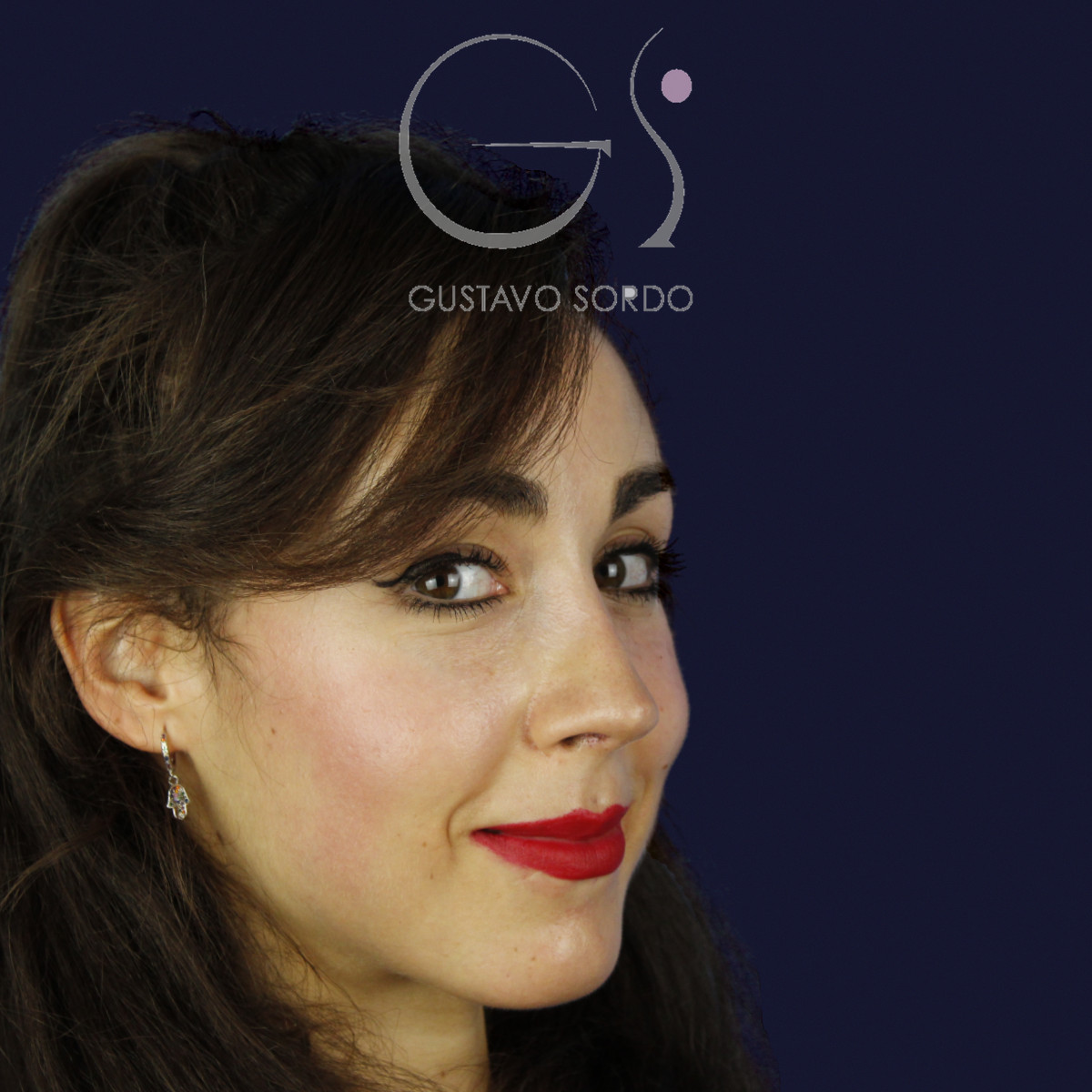 Rinoplastia estructural en piel fina con giba en S, semiperfil derecho, al año de la operación — caso del Dr. Gustavo Sordo en Madrid