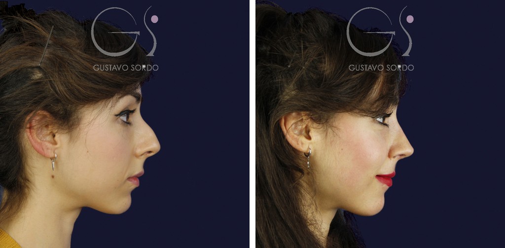 Rinoplastia — técnica ultrasónica: antes y después de un caso operado en Madrid