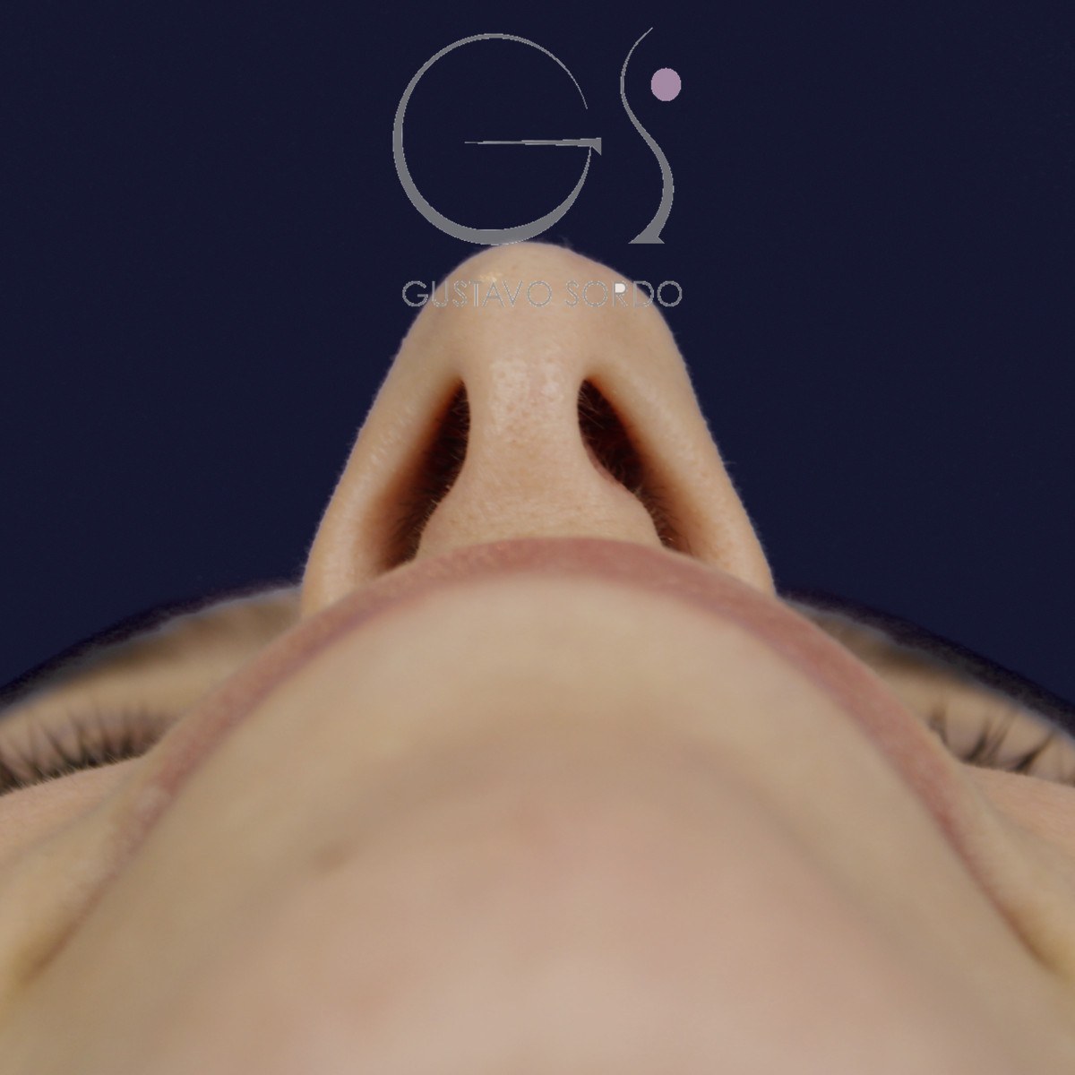 Rinoplastia ultrasónica en nariz aguileña, vista basal: antes de la operación