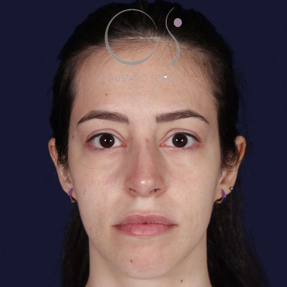 Rinoplastia ultrasónica en nariz aguileña, de frente: resultado a los dos años