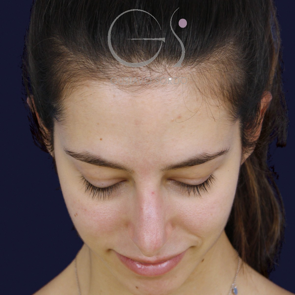 Rinoplastia ultrasónica en nariz aguileña, mentón abajo: antes de la operación