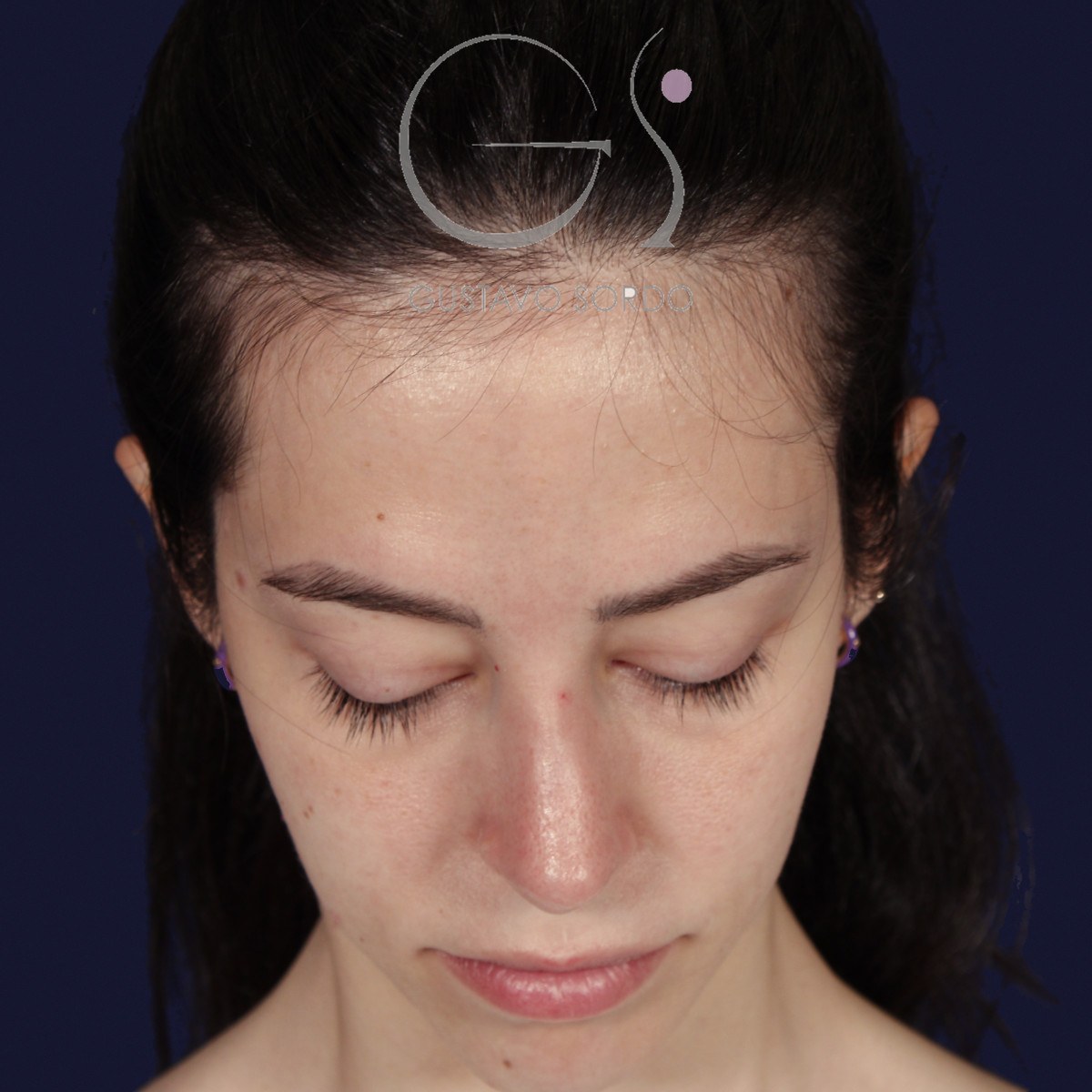 Rinoplastia ultrasónica en nariz aguileña, mentón abajo: resultado a los dos años