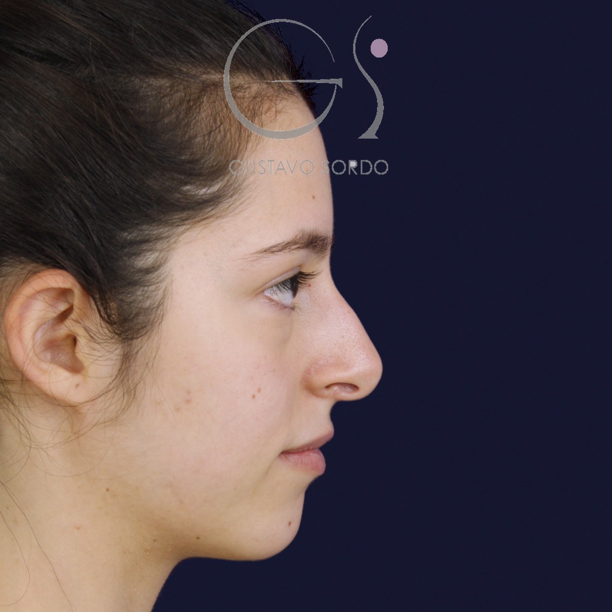 Rinoplastia ultrasónica en nariz aguileña, perfil derecho: antes de la operación
