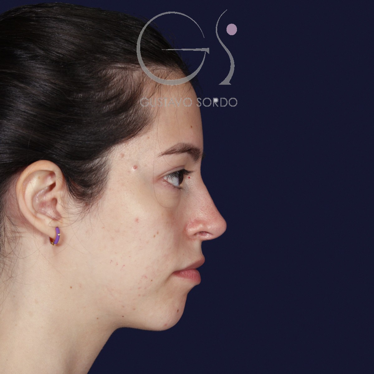 Rinoplastia ultrasónica en nariz aguileña, perfil derecho: resultado a los dos años