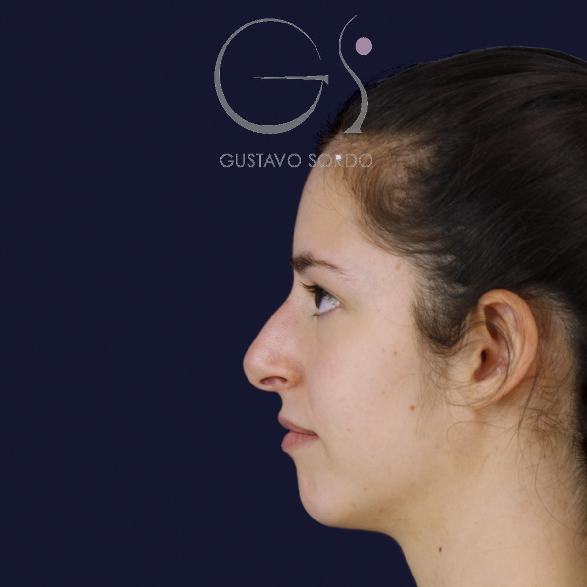 Rinoplastia ultrasónica en nariz aguileña, perfil izquierdo: antes de la operación