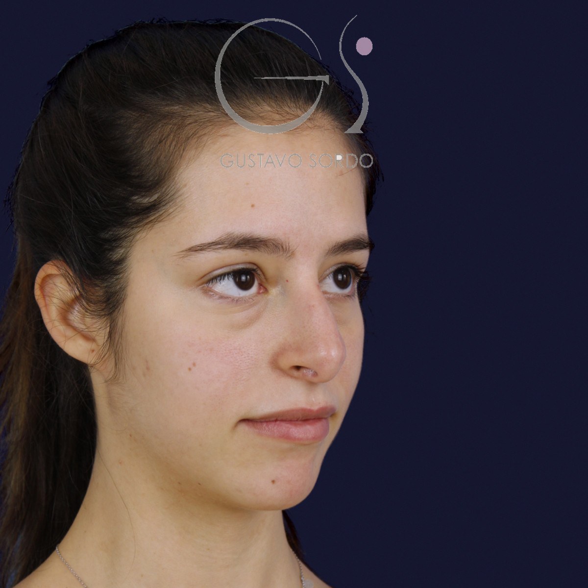 Rinoplastia ultrasónica en nariz aguileña, semiperfil derecho: antes de la operación