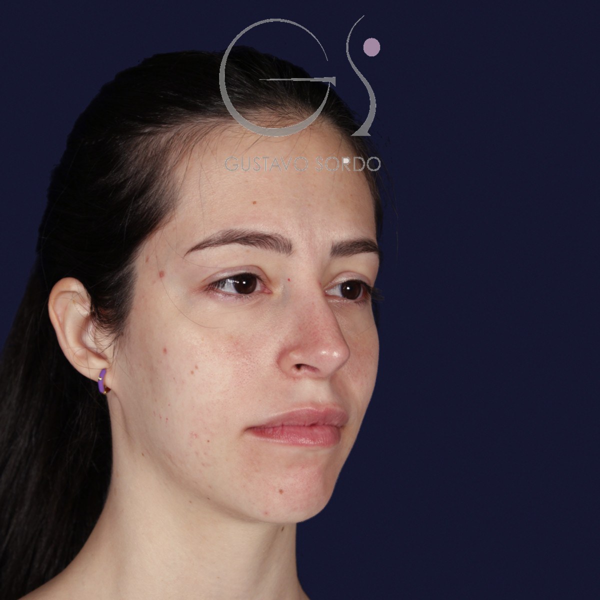 Rinoplastia ultrasónica en nariz aguileña, semiperfil derecho: resultado a los dos años