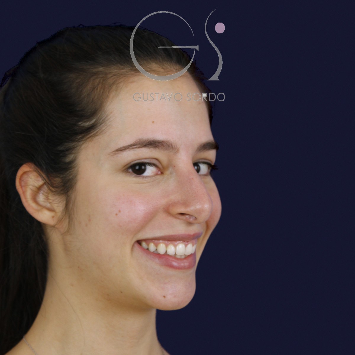 Rinoplastia ultrasónica en nariz aguileña, semiperfil derecho sonriendo: antes de la operación
