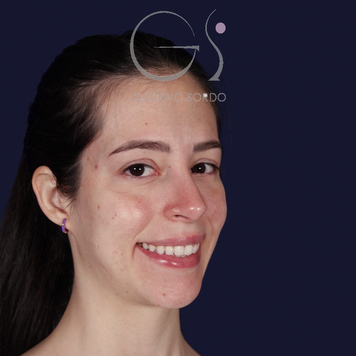 Rinoplastia ultrasónica en nariz aguileña, semiperfil derecho sonriendo: resultado a los dos años