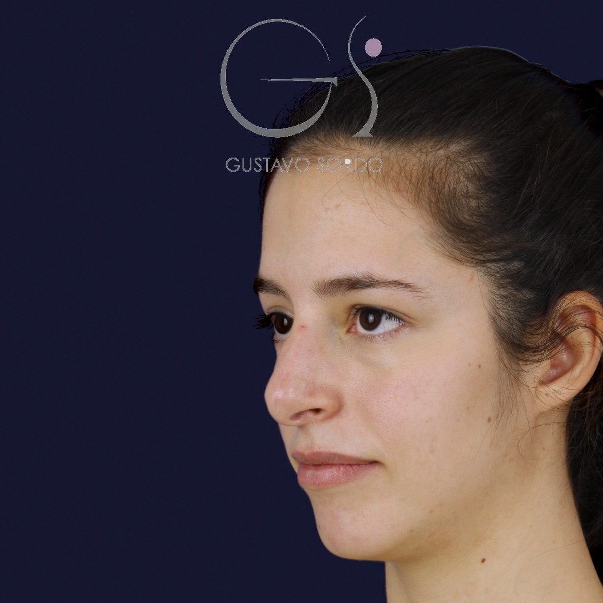 Rinoplastia ultrasónica en nariz aguileña, semiperfil izquierdo: antes de la operación