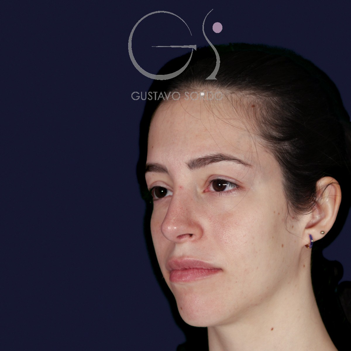 Rinoplastia ultrasónica en nariz aguileña, semiperfil izquierdo: resultado a los dos años