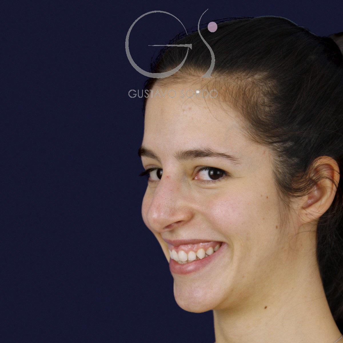 Rinoplastia ultrasónica en nariz aguileña, semiperfil izquierdo sonriendo: antes de la operación