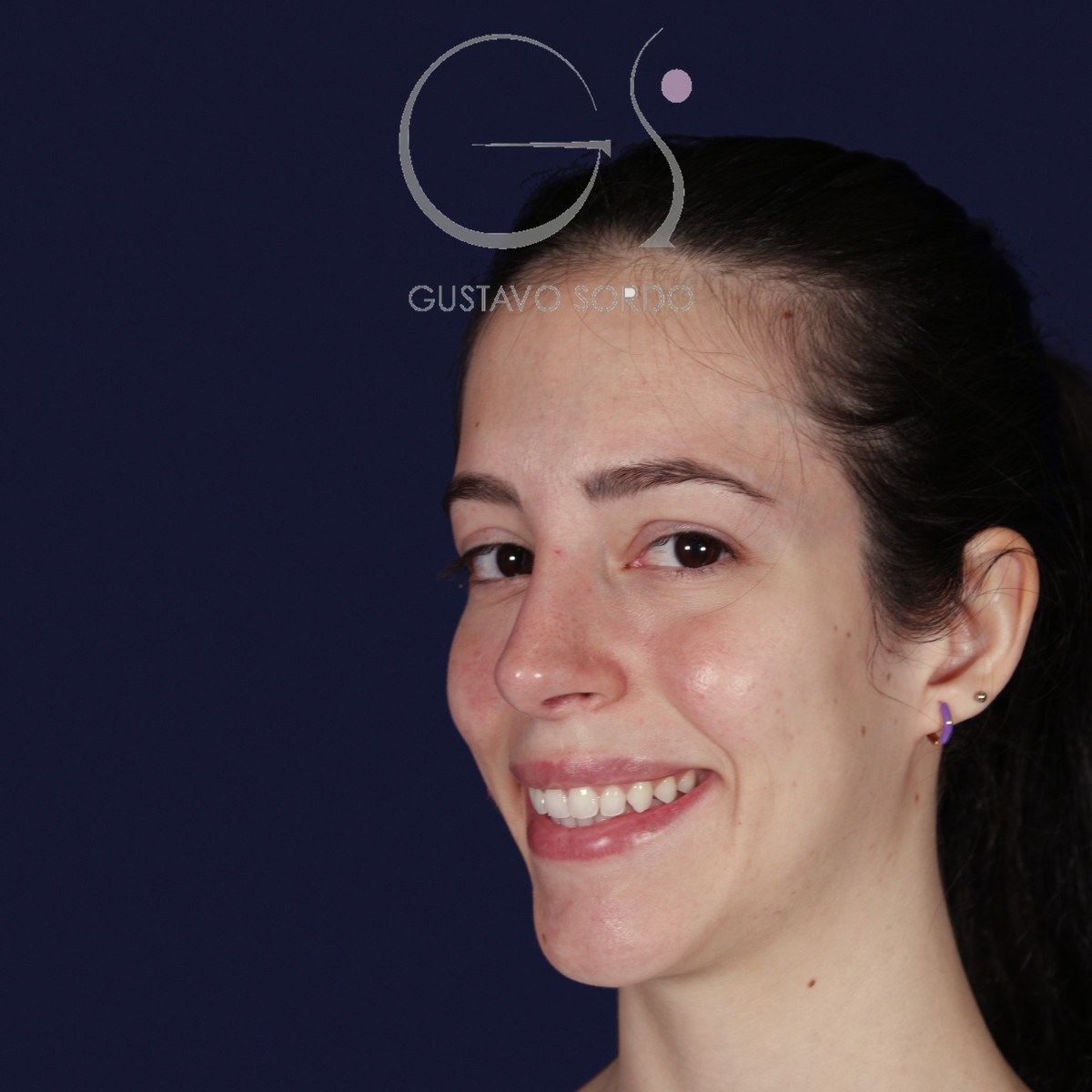 Rinoplastia ultrasónica en nariz aguileña, semiperfil izquierdo sonriendo: resultado a los dos años