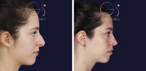 Rinoplastia ultrasónica en nariz aguileña
