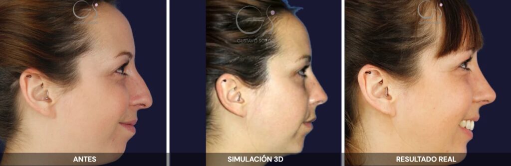 Rinoplastia ultrasónica de perfil: antes, simulación 3D y resultado real de la misma paciente, operada por el Dr. Gustavo Sordo en Madrid
