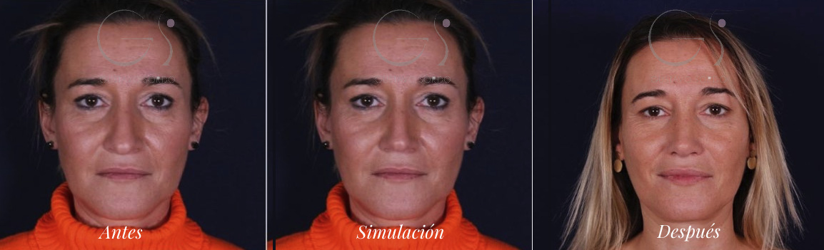 Rinoplastia de frente: antes, simulación y resultado real de la misma paciente