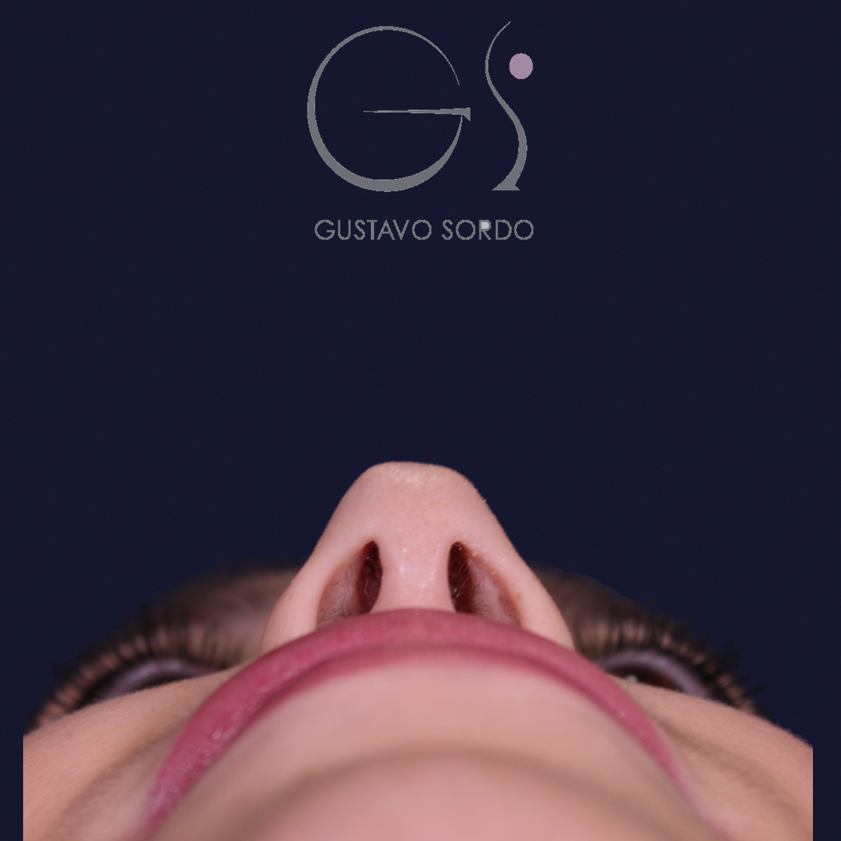 Después de rinoplastia estilo Barbie en piel fina, al año, vista basal