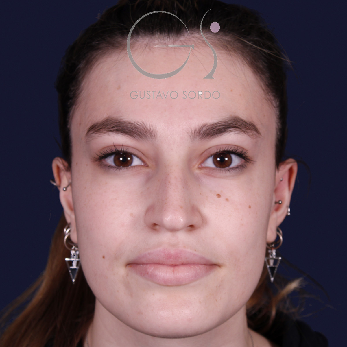 Antes de rinoplastia estilo Barbie en piel fina, vista frontal