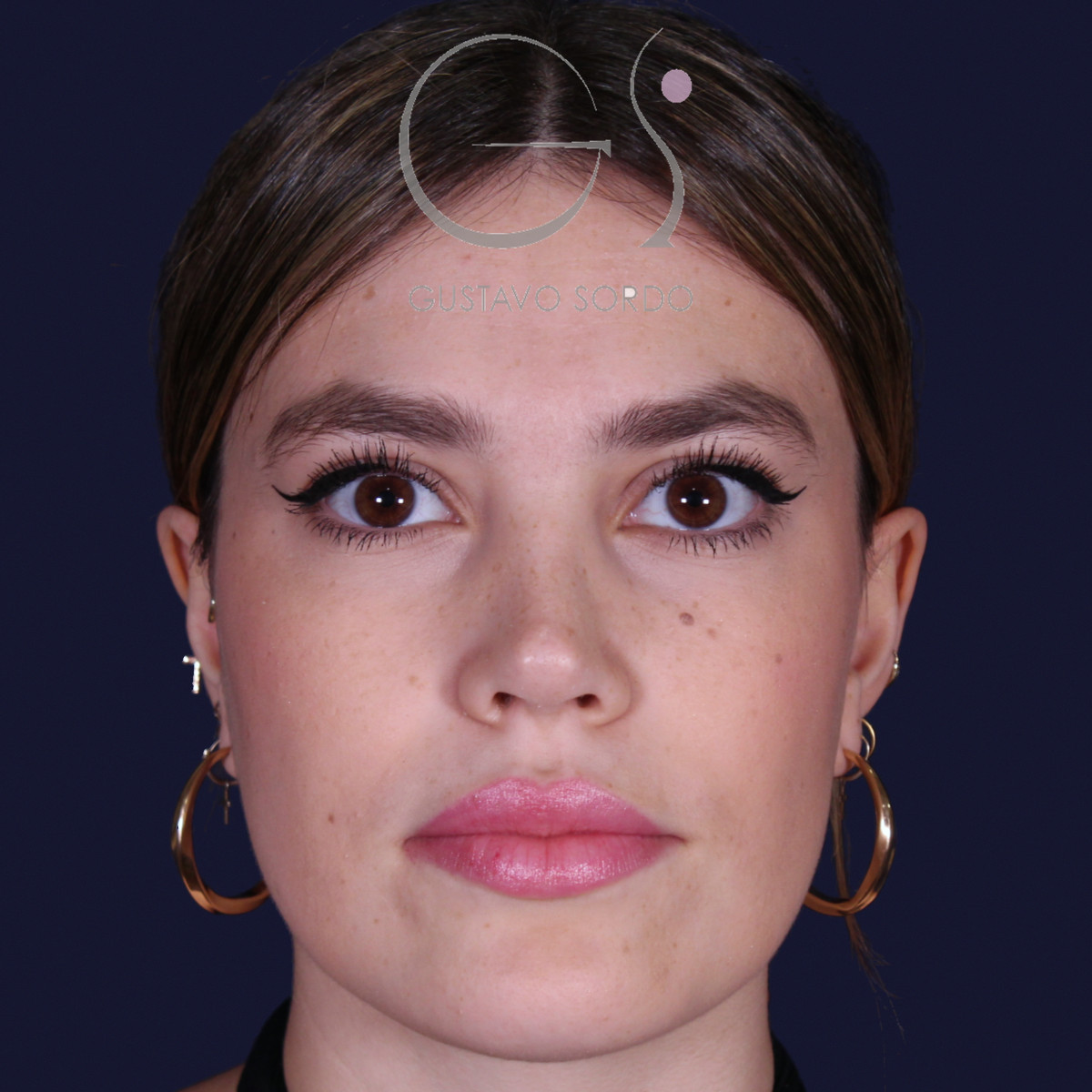 Después de rinoplastia estilo Barbie en piel fina, al año, vista frontal
