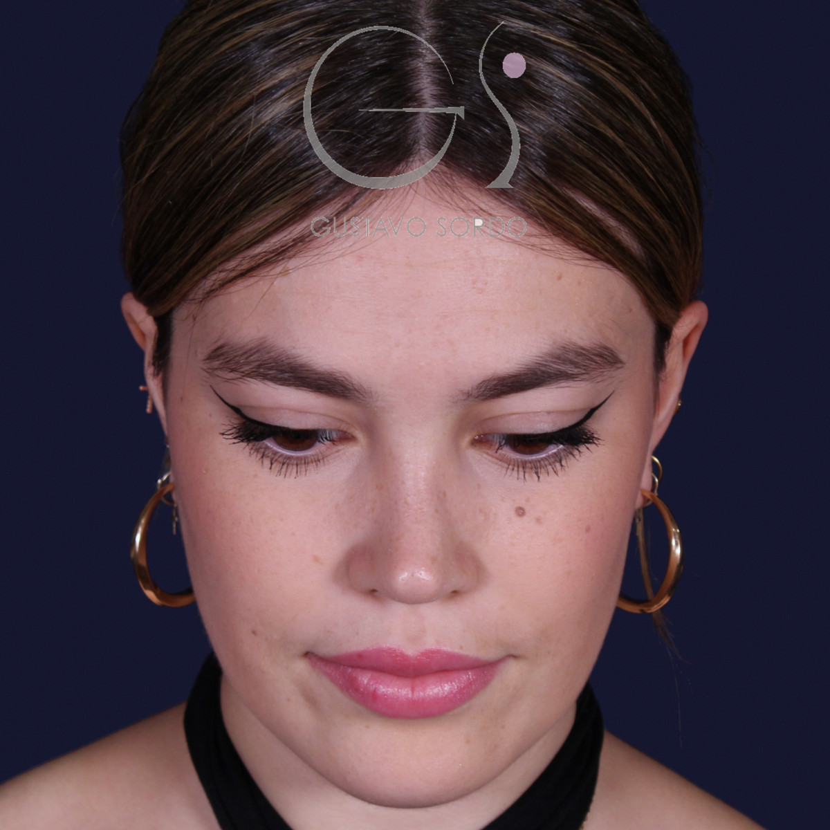Después de rinoplastia estilo Barbie en piel fina, al año, vista frontal con el mentón abajo