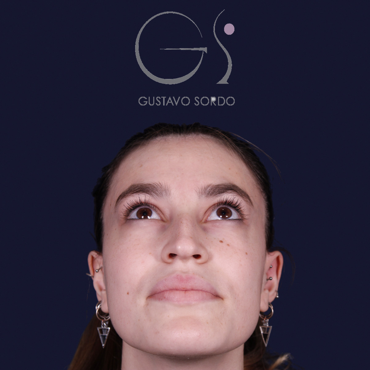 Antes de rinoplastia estilo Barbie en piel fina, vista frontal con el mentón arriba
