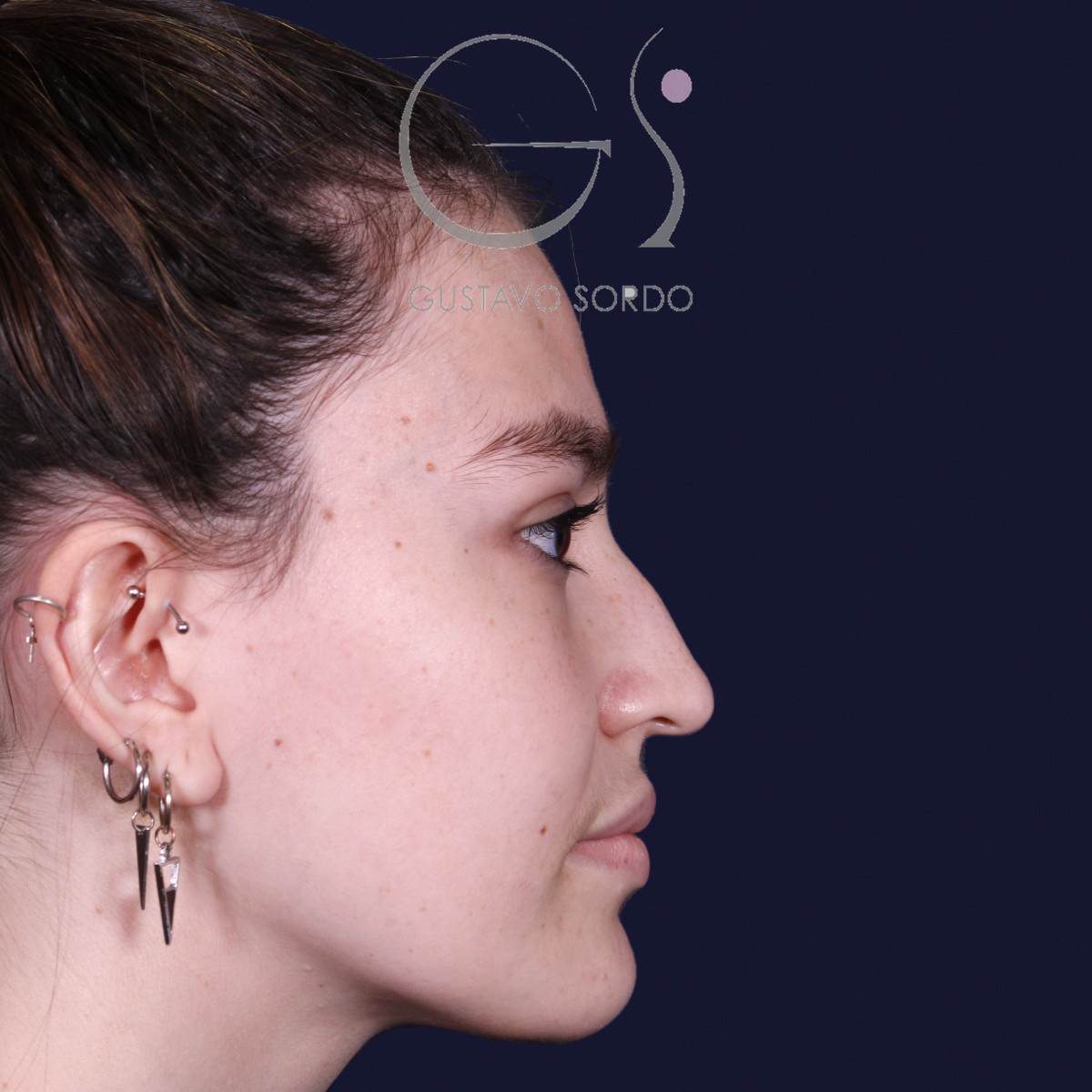 Antes de rinoplastia estilo Barbie en piel fina, vista de perfil derecho