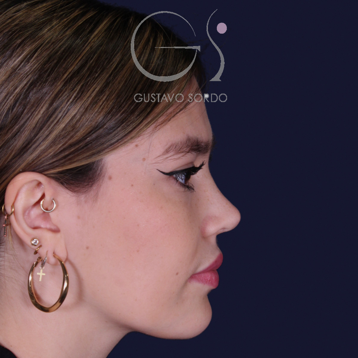 Después de rinoplastia estilo Barbie en piel fina, al año, vista de perfil derecho