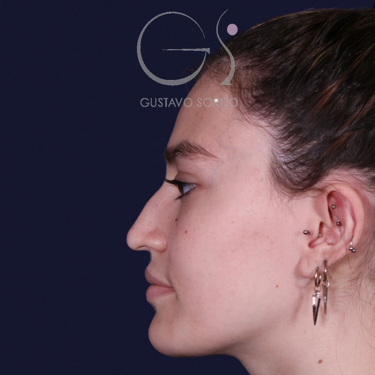 Antes de rinoplastia estilo Barbie en piel fina, vista de perfil izquierdo