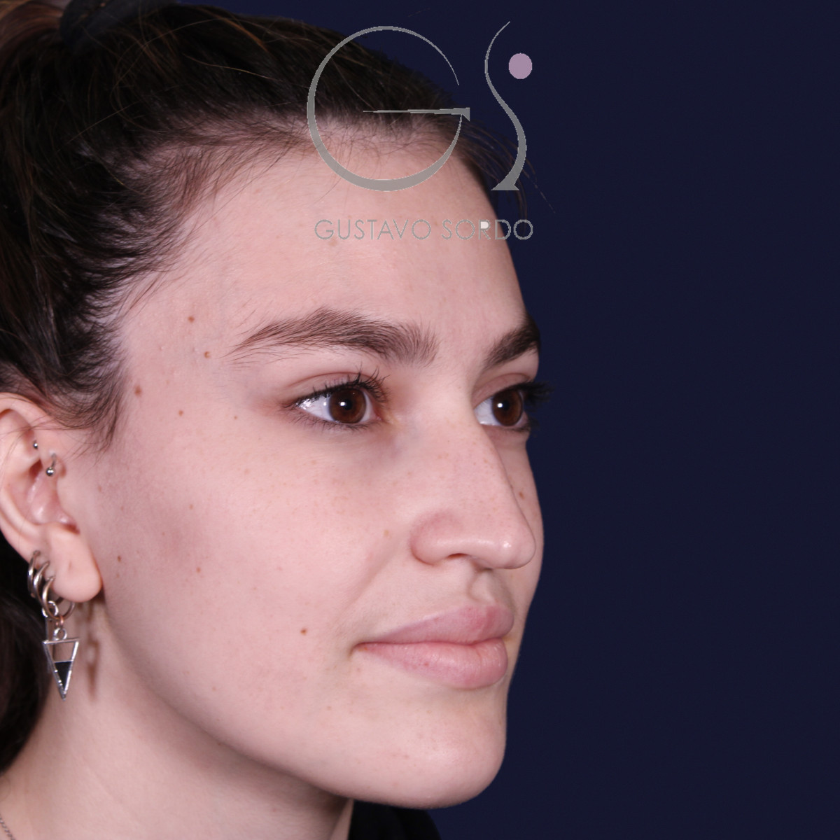 Antes de rinoplastia estilo Barbie en piel fina, vista de semiperfil derecho