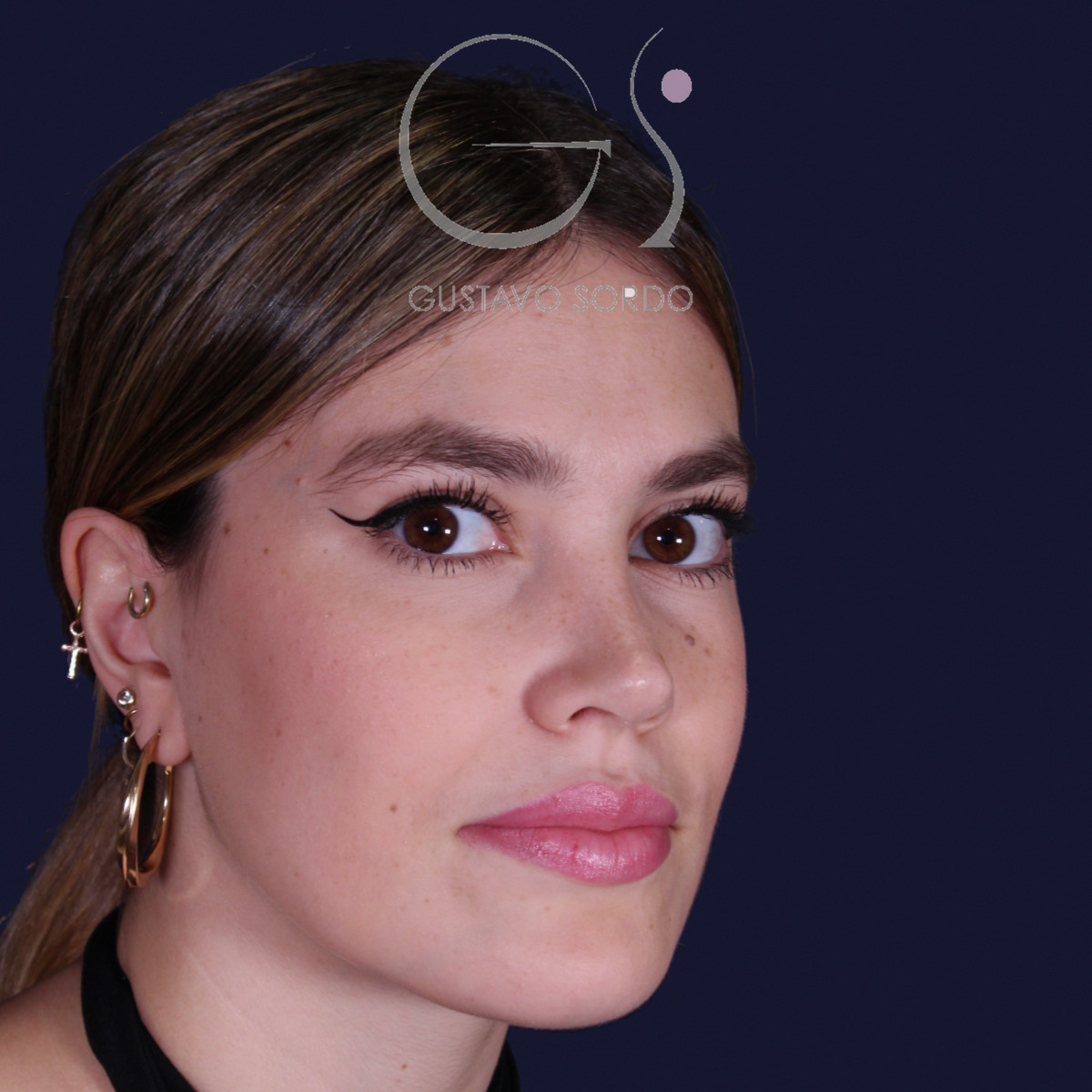 Después de rinoplastia estilo Barbie en piel fina, al año, vista de semiperfil derecho