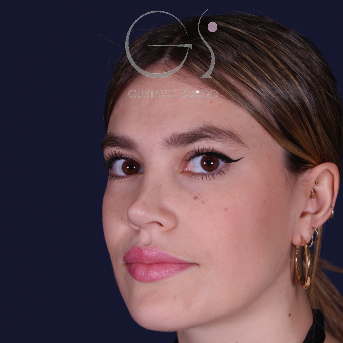 Después de rinoplastia estilo Barbie en piel fina, al año, vista de semiperfil izquierdo