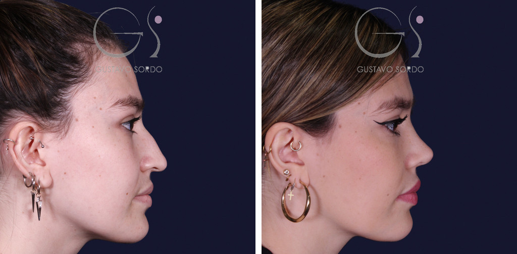 Rinoplastia estilo Barbie en piel fina: antes y al año, perfil derecho