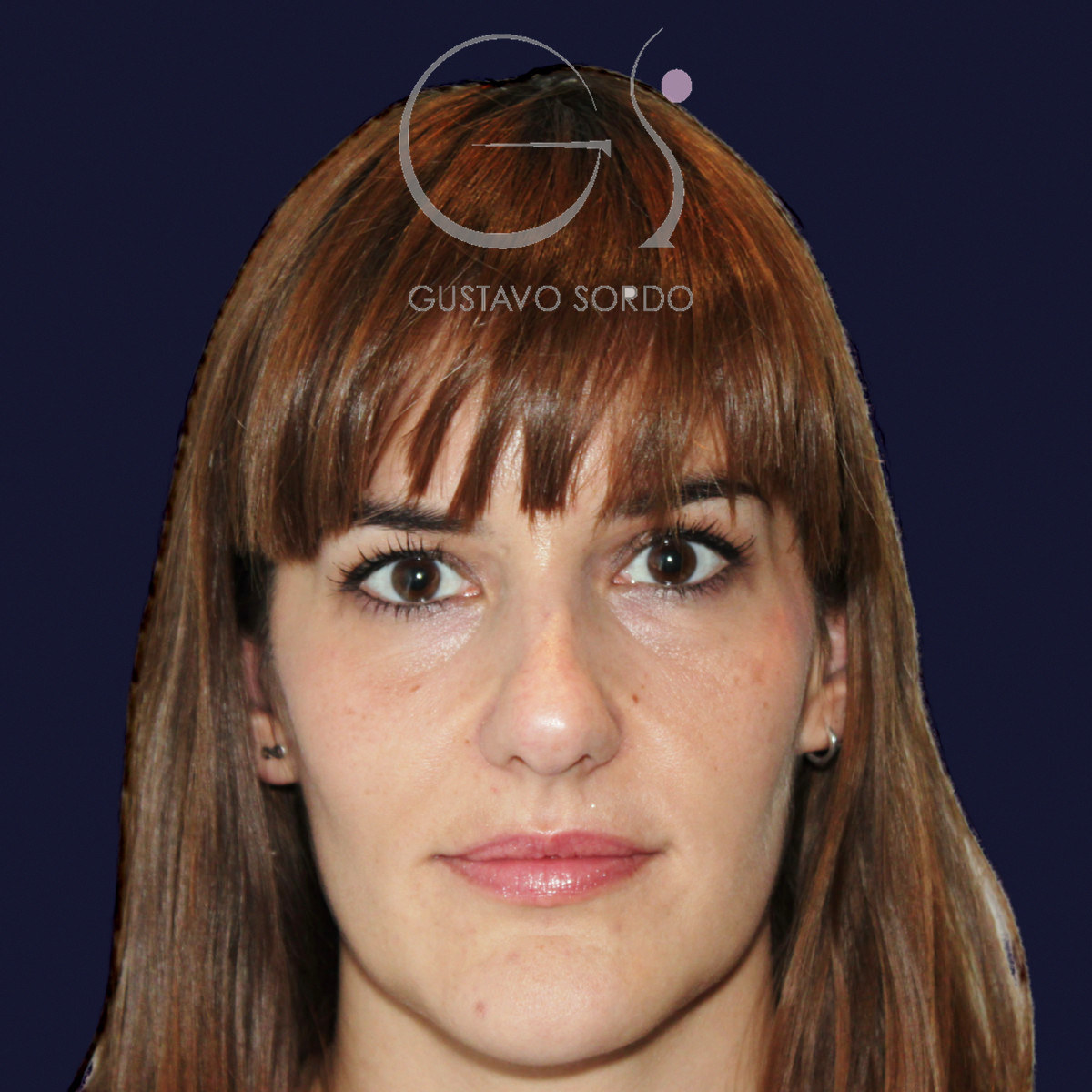 Antes de rinoplastia para reducir el caballete y corregir la punta, vista frontal