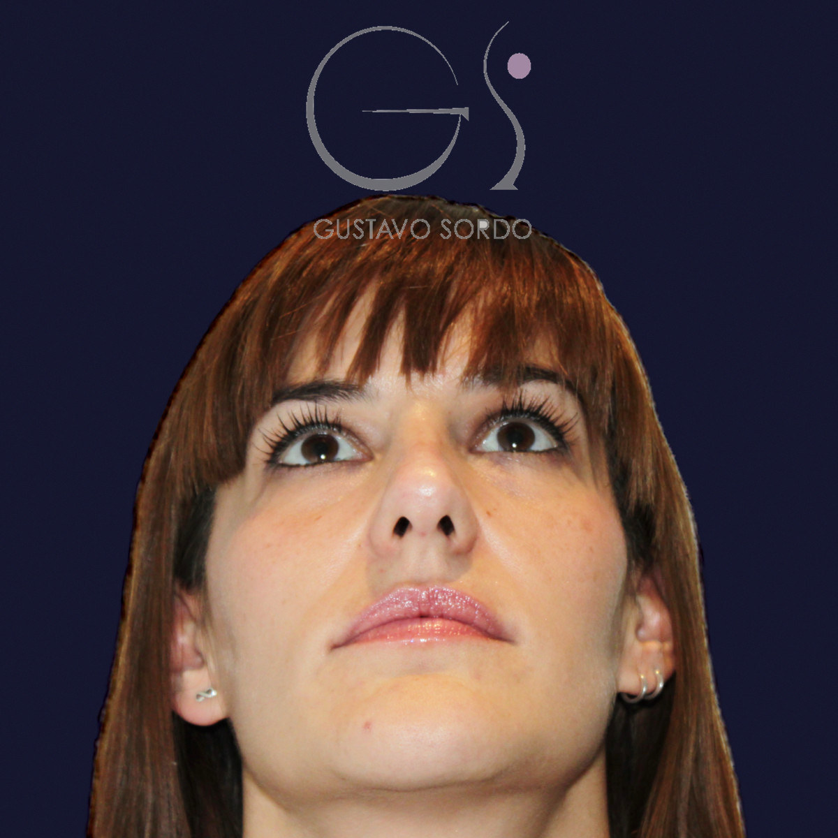 Antes de rinoplastia para reducir el caballete y corregir la punta, vista frontal con el mentón arriba