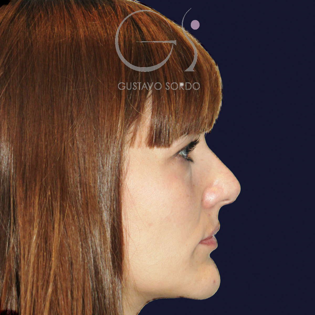 Antes de rinoplastia para reducir el caballete y corregir la punta, vista de perfil derecho