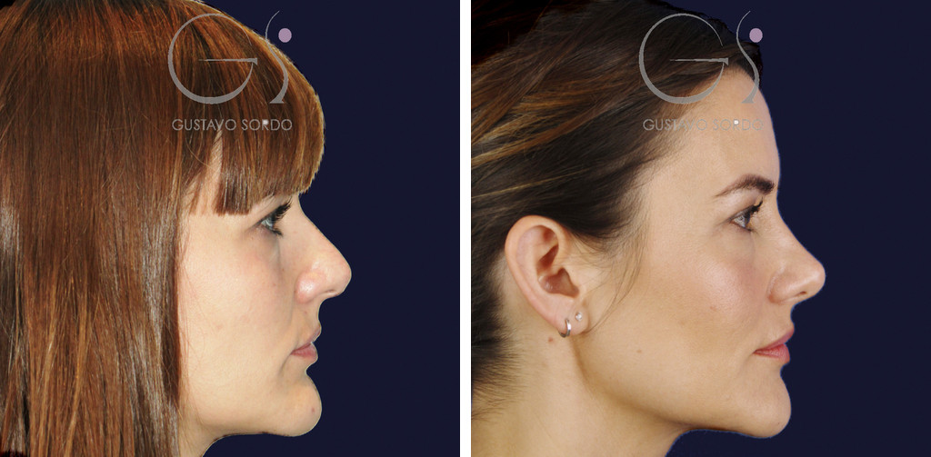 Rinoplastia para reducir el caballete y corregir la punta: antes y a los cinco años, vista de perfil derecho
