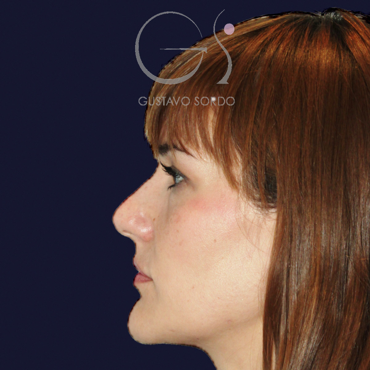 Antes de rinoplastia para reducir el caballete y corregir la punta, vista de perfil izquierdo