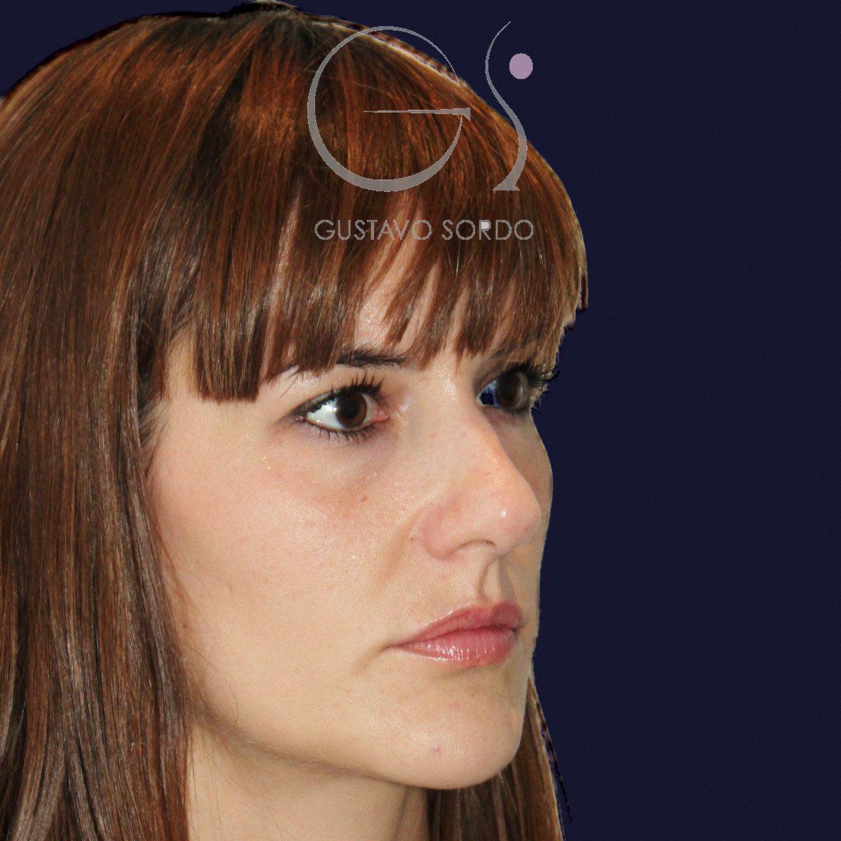 Antes de rinoplastia para reducir el caballete y corregir la punta, vista de semiperfil derecho