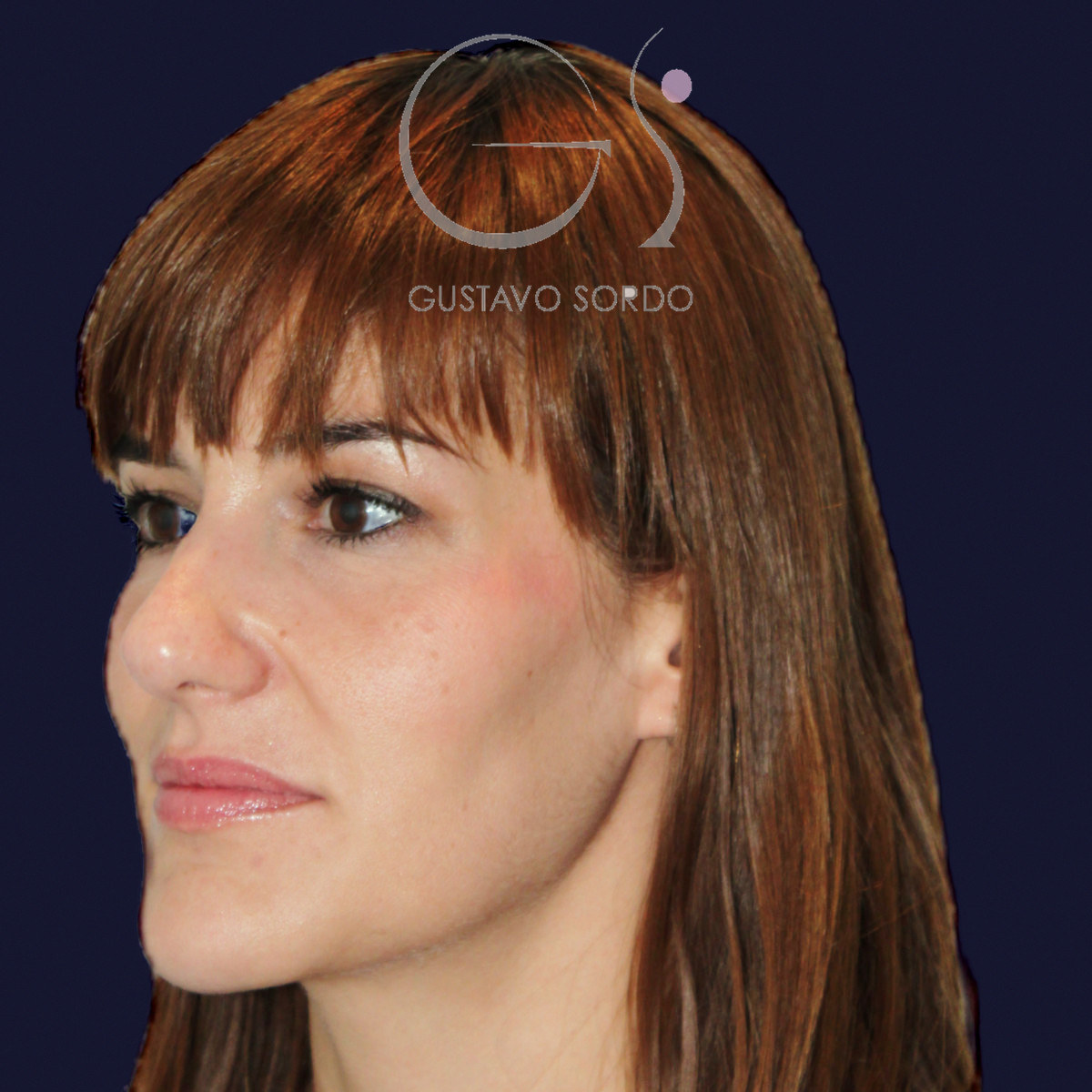 Antes de rinoplastia para reducir el caballete y corregir la punta, vista de semiperfil izquierdo