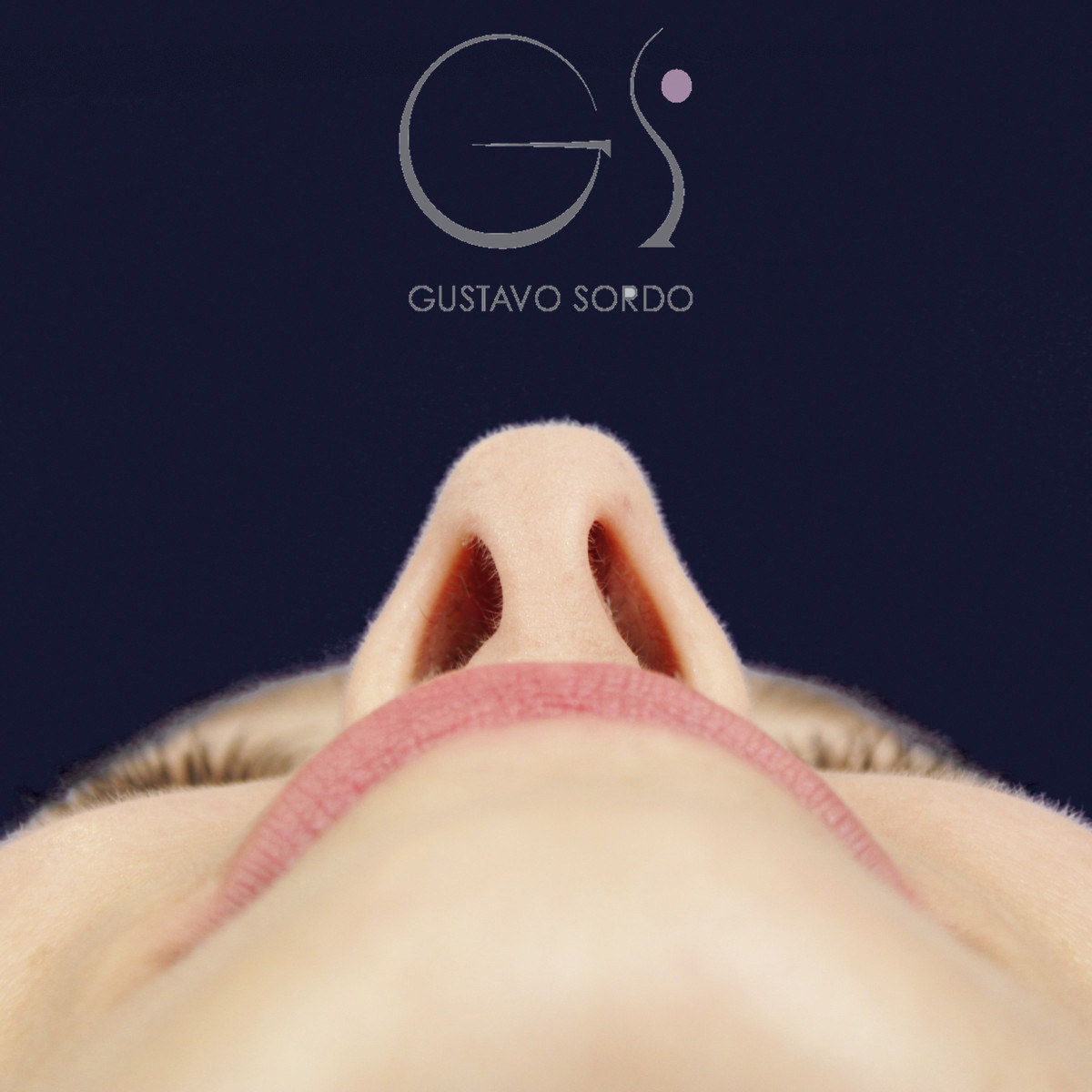 Antes de rinoplastia ultrasónica con columela colgante y ala retraída, vista basal