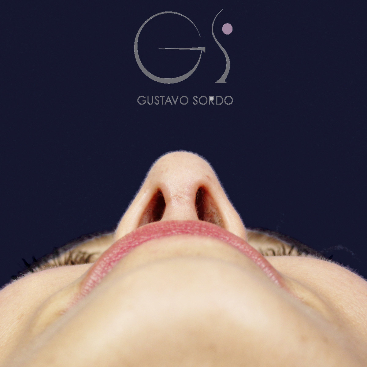 Después de rinoplastia ultrasónica con columela colgante y ala retraída, a los dos meses, vista basal