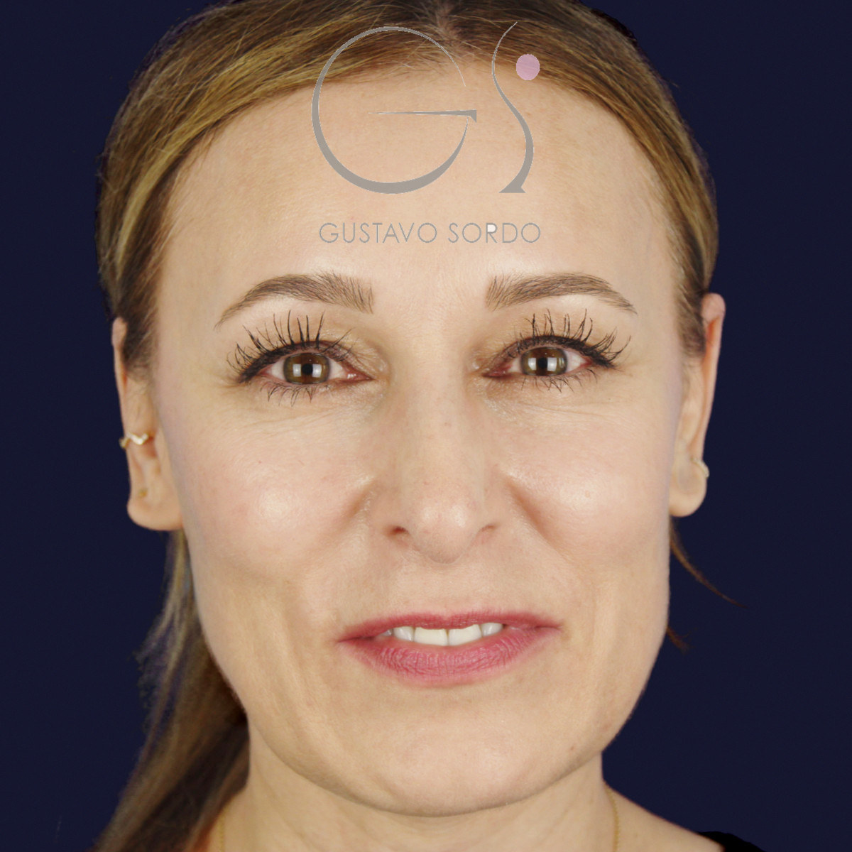 Antes de rinoplastia ultrasónica con columela colgante y ala retraída, vista frontal