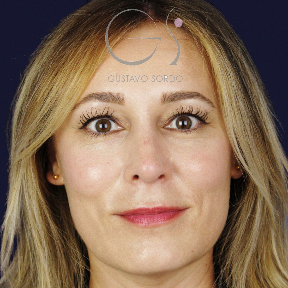 Después de rinoplastia ultrasónica con columela colgante y ala retraída, a los dos meses, vista frontal