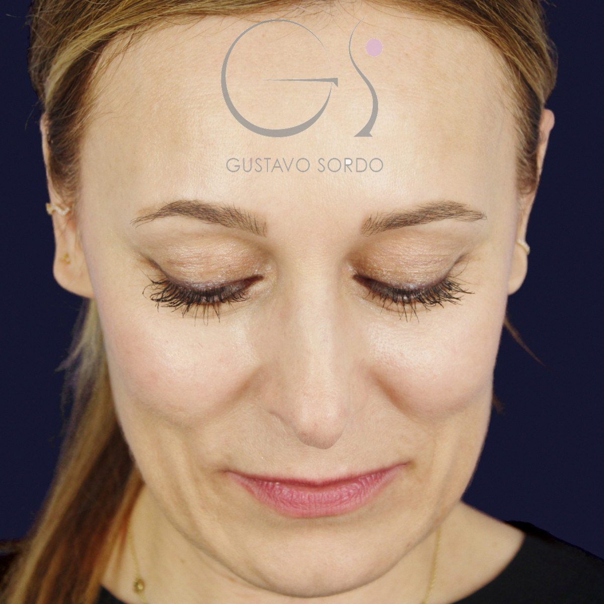 Antes de rinoplastia ultrasónica con columela colgante y ala retraída, vista frontal con el mentón abajo